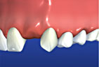 Redding-Dentist-Dental-bridges-1