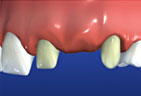 Redding-Dentist-Dental-bridges-2