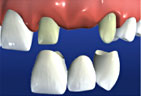 Redding-Dentist-Dental-bridges-3