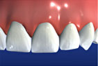 Redding-Dentist-Dental-bridges-4