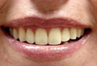 Redding-Dentist-Take-Home_Whiteniing-3