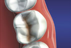 Redding-Dentist-inlays-onlays-1