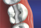 Redding-Dentist-inlays-onlays-2