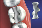 Redding-Dentist-inlays-onlays-3