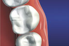 Redding-Dentist-inlays-onlays-4