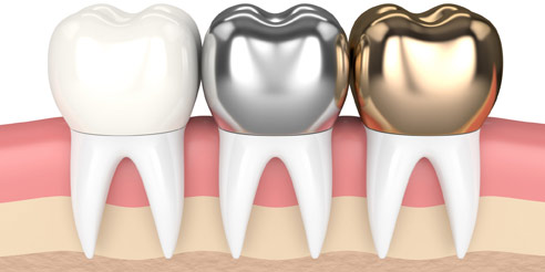 Types of Dental Crowns in Redding, CA